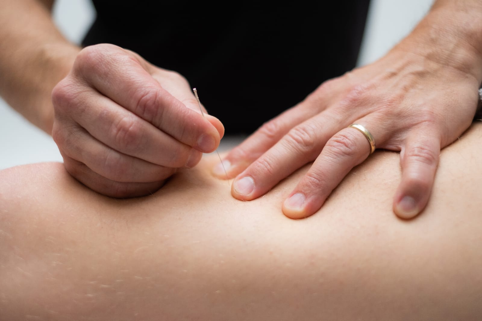 Dry needling behandling av triggerpunkter hos CorOptima