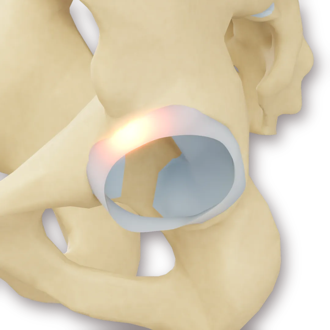3D-modell der en rift i fremre-øvre del av labrum er markert i korall