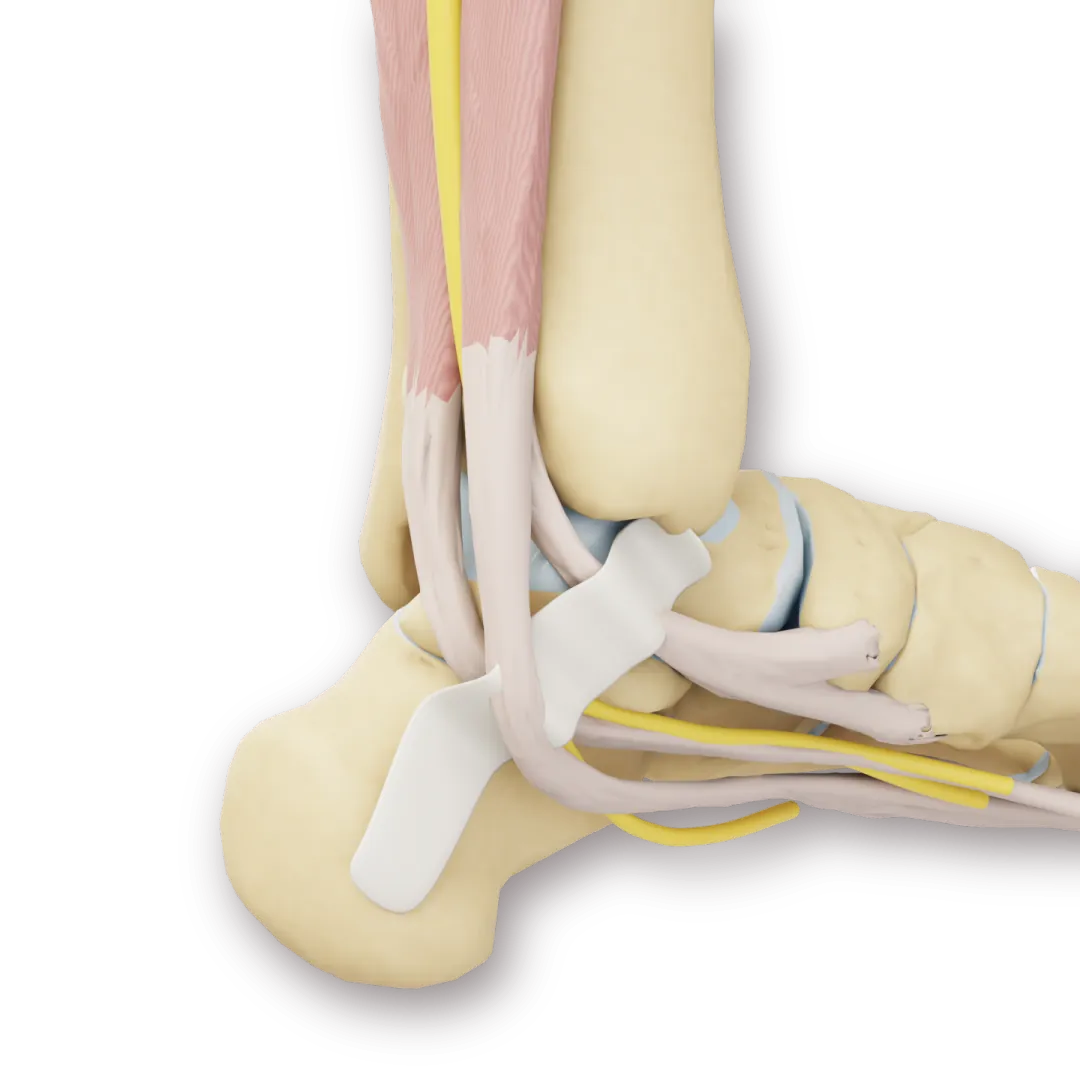 3D-modell der tibialisnerven går bak den indre ankelknoken sammen med senene
